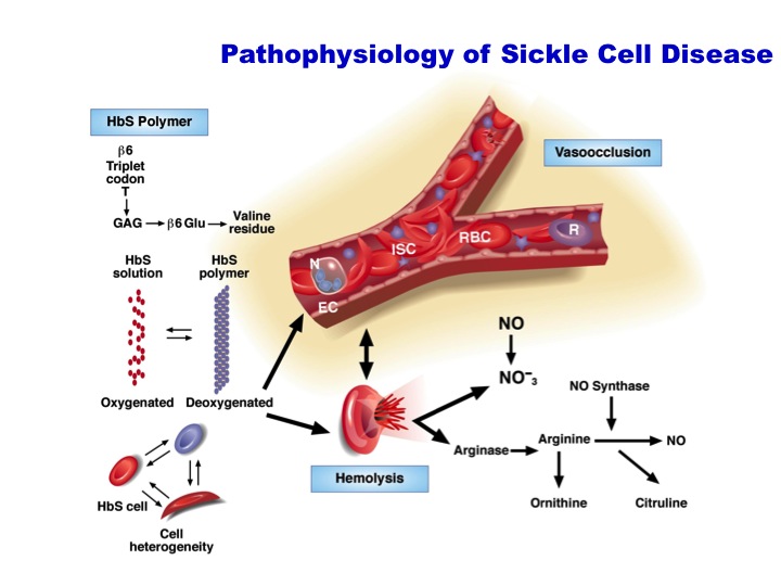 sickle cell disease research article